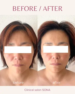 小顔/たるみ/黒ずみ除去専門サロン/SONA 大和西大寺店所属・【小顔専門看護師 サロンSONA】のエステ・リラクイメージ