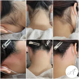 A*[エースター] シュガーリング🍋のエステ・リラクイメージ