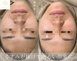 ハーブピーリング・毛穴ケア専門サロンSalon de LENA 栄店所属・ハーブピーリング専門 サロンドレナ　白藤のエステ・リラクイメージ