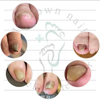 ネイル Mellow nail所属・巻爪無料モデル募集 ✨🦶MEGUMIのネイルデザイン