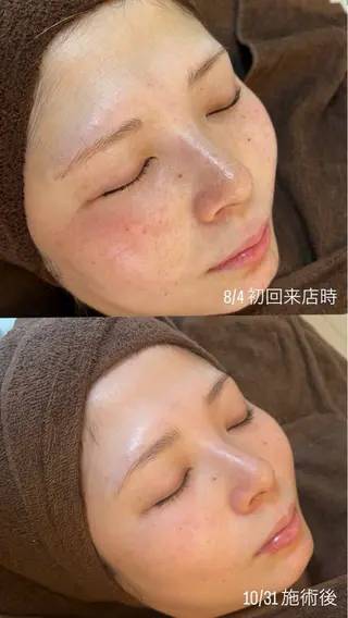 肌質改善|美眉サロンCannone'所属・肌質改善|美眉サロン Cannone’のエステ・リラクイメージ