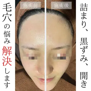 ハーブピーリング・毛穴ケア専門サロンSalon de LENA所属・ハーブピーリング 専門店/名古屋駅前店のエステ・リラクイメージ