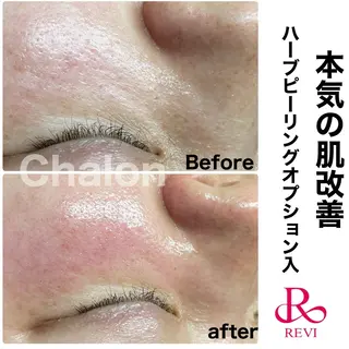 Chalon所属・REVI取扱・肌悩み 改善　Chalonのエステ・リラクイメージ