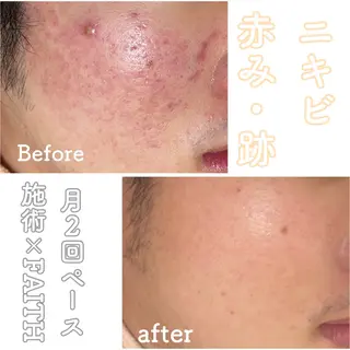 ニキビ&跡改善サロン オーナー光木のエステ・リラクイメージ