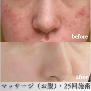 学生ニキビ改善🍀 優しい肌質改善のエステ・リラクイメージ