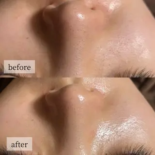 HINANO矢場町店【ヒナノ】所属・脱毛/肌改善🌿 HINANO 村田のエステ・リラクイメージ