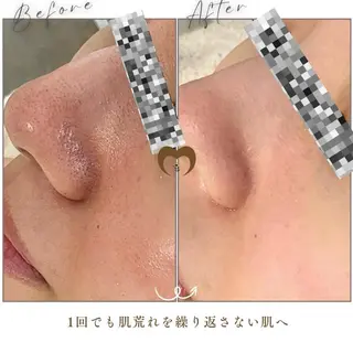ニキビケア/肌質専門 悩まない肌に✨森園のエステ・リラクイメージ