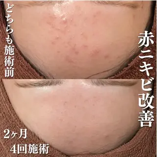 皮膚科より効果あり ⁉️最短ニキビ改善のエステ・リラクイメージ