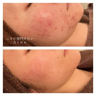 セミロング パーマ ヘアアレンジ メンズ キッズ ネイル マツエク・マツパ アイブロウ ニキビ跡専門サロン Ainaのエステ・リラクイメージ