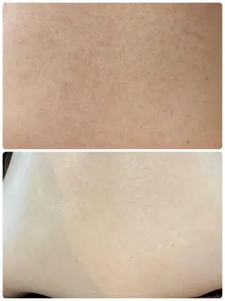 【ハーブピーリング/毛穴洗浄】NA skin 川崎店〜ニキビ・毛穴専門店〜所属・NAホワイトニング 川崎店のエステ・リラクイメージ