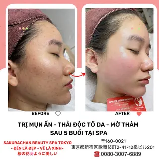 ニキビ、痩身、脱毛、 サクラチャンスパのエステ・リラクイメージ