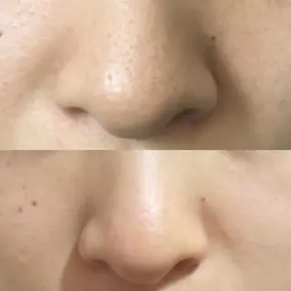 ニキビ毛穴改善 🌿ハーブピーリングのエステ・リラクイメージ