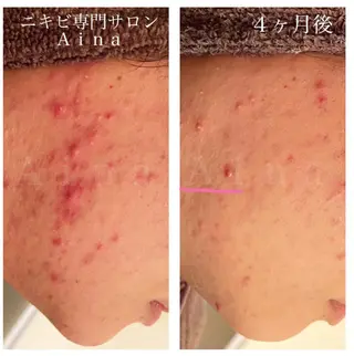 セミロング パーマ ヘアアレンジ メンズ キッズ ネイル マツエク・マツパ アイブロウ ニキビ跡専門サロン Ainaのエステ・リラクイメージ