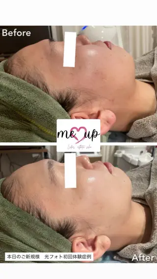 Meupニキビ専門店 背中/ハーブ/ララのその他イメージ