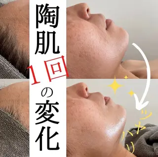 ハーブピーリング/韓国肌管理/フェイシャル/毛穴洗浄/眉毛/顔脱毛【糸脱毛専門】rev所属・肌質改善❤️美眉 脱毛🍒糸脱毛サロンのエステ・リラクイメージ