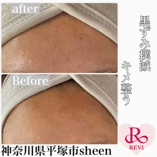 Chalon所属・REVI取扱・肌悩み 毛穴Chalonのエステ・リラクイメージ