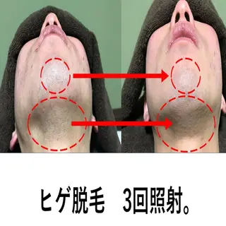 メンズ マンモス脱毛 札幌白石店のその他イメージ