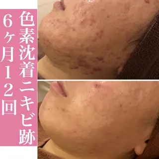 学生ニキビ改善🍀 優しい肌質改善のエステ・リラクイメージ
