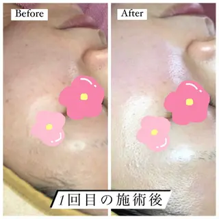 ニキビ/敏感肌/乾燥 Lilyauraのエステ・リラクイメージ