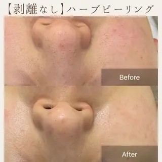 肌質改善サロン renew所属・肌質改善サロン renew/ｳｴｷのエステ・リラクイメージ