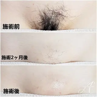 A*[エースター] シュガーリング🍋のエステ・リラクイメージ