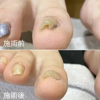 ネイル 深爪・巻き爪 専門サンセリテのネイルデザイン