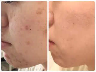 ニキビ・ 肌荒れ専門店のエステ・リラクイメージ