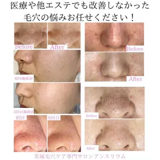 毛穴ケア専門サロンアンスリウム所属・茨城土浦 つくば毛穴 ケア専門サロンのエステ・リラクイメージ