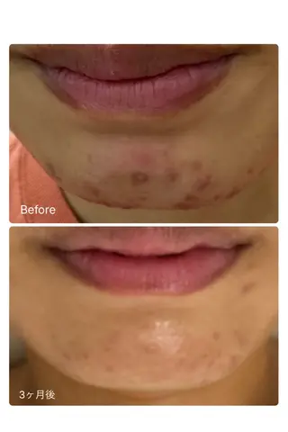 ナリスビューティサロンあべの所属・肌質改善/ツヤ肌作り /松本杏奈のエステ・リラクイメージ