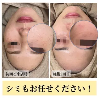 ハーブピーリング・毛穴ケア専門サロンSalon de LENA所属・ハーブピーリング 毛穴専門店/栄のエステ・リラクイメージ