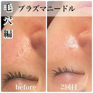 毛穴レス ハーブ& ワックス脱毛×光脱毛のエステ・リラクイメージ