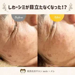 ニキビケア/毛穴/ 赤み/自信の肌✨森園のエステ・リラクイメージ