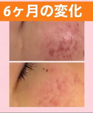 メンズ キッズ ニキビ 専門のエステ・リラクイメージ