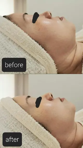 ニキビケア&ニキビ跡 レゾン京橋店 のエステ・リラクイメージ