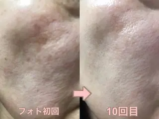 肌ケア＆毛穴洗浄 Cheriのエステ・リラクイメージ