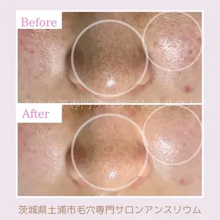 毛穴ケア専門サロンアンスリウム所属・茨城土浦 つくば毛穴 ケア専門サロンのエステ・リラクイメージ
