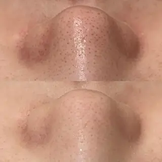 ダウンタイムなし✨ 敏感肌さん用エステのエステ・リラクイメージ