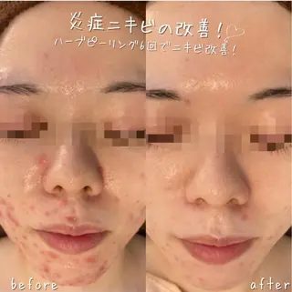 【ハーブピーリング/毛穴洗浄】NA skin 川崎店〜ニキビ・毛穴専門店〜所属・NAホワイトニング 川崎店のエステ・リラクイメージ