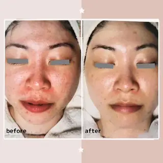 ニキビケア&ニキビ跡 レゾン京橋店 のエステ・リラクイメージ