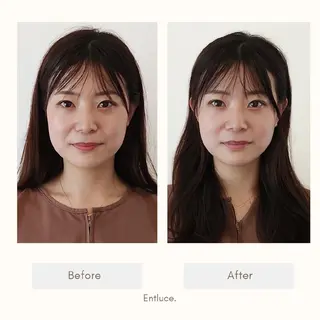 即効⚡小顔美容鍼🪡 むくみたるみ脂肪解消のエステ・リラクイメージ