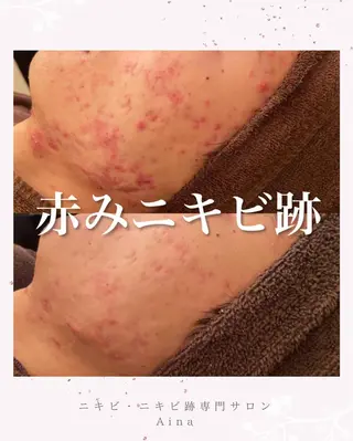 セミロング パーマ ヘアアレンジ キッズ ネイル マツエク・マツパ アイブロウ ニキビ跡専門サロン Ainaのエステ・リラクイメージ