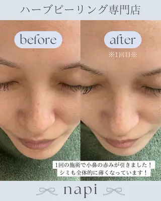 ハーブピーリング 専門店napiのエステ・リラクイメージ