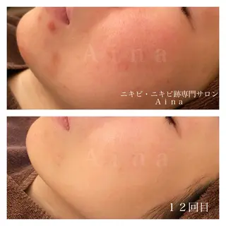 ニキビ跡専門サロン Ainaのエステ・リラクイメージ
