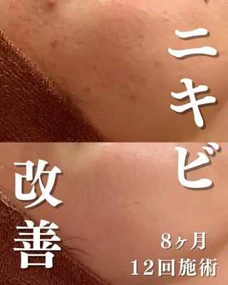 撲滅🔥 最短ニキビ改善のエステ・リラクイメージ