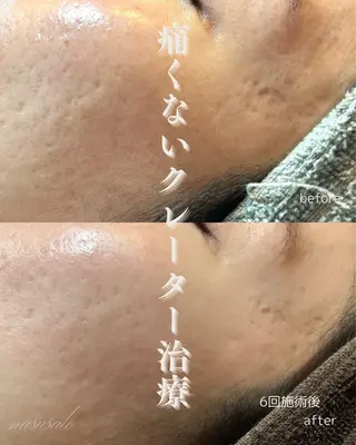 肌育×小顔×毛穴洗浄 ナスサロ 看護師只野のエステ・リラクイメージ