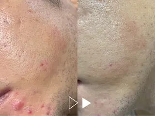 メンズ 肌質改善サロン🌕 ⠀【ルーナピエナ】のエステ・リラクイメージ