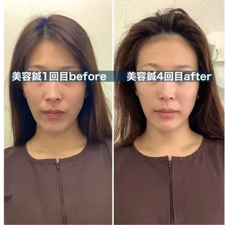 hari salon de off 美容鍼灸×小顔整体【ハリサロンドオフ】所属・美容鍼×小顔整体🤍 ishibashiのエステ・リラクイメージ