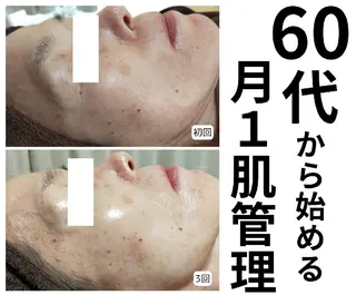 【ニキビ改善】 肌育ハーブピーリングのエステ・リラクイメージ