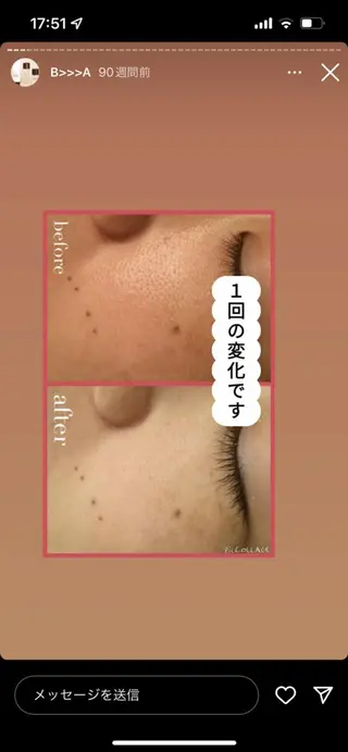 皮膚科より効果あり ⁉️最短ニキビ改善のエステ・リラクイメージ