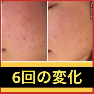 学生ニキビ改善🍀 優しい肌質改善のエステ・リラクイメージ